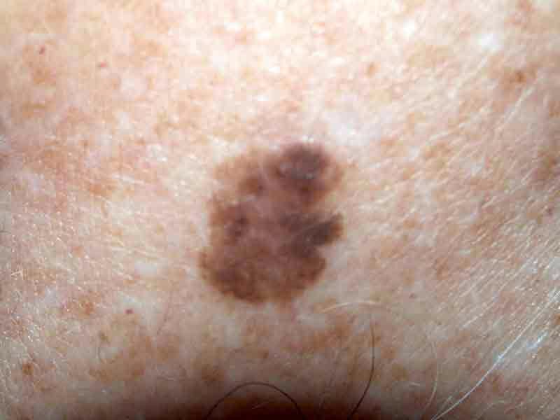 Types Of Skin Cancer On Arms