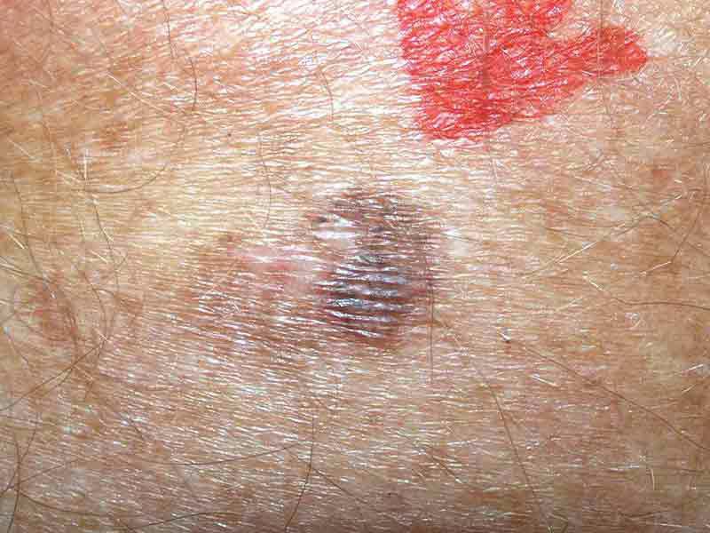 Skin Cancer Spots On Arm - vrogue.co